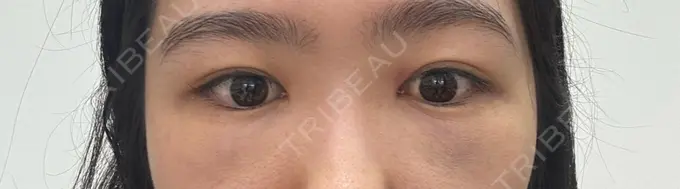 クマ治療 / 下まぶたの脂肪取り RIVER CLINIC（リバークリニック） DAY 2 メイン用