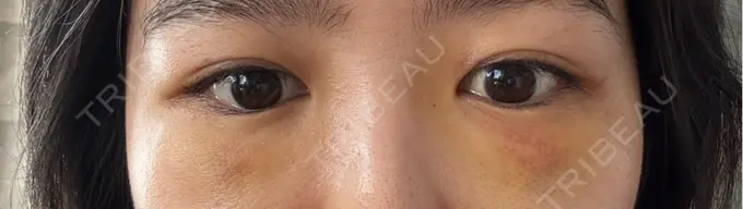 クマ治療 / 下まぶたの脂肪取り RIVER CLINIC（リバークリニック） DAY 3 メイン用