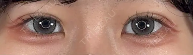 二重埋没 / 小鼻縮小（非切開） / ヒアルロン酸注入（涙袋） アリエル美容クリニック 横浜院 DAY 12 メイン用