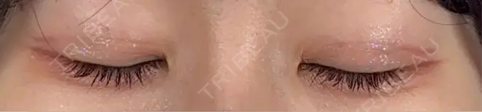 二重埋没 / 小鼻縮小（非切開） / ヒアルロン酸注入（涙袋） アリエル美容クリニック 横浜院 DAY 12 メイン用