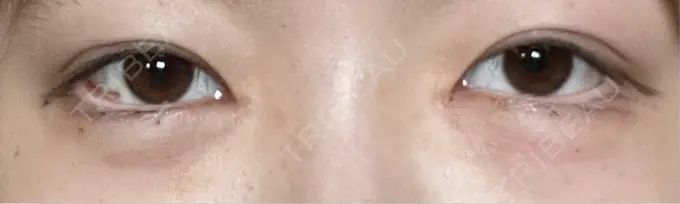 クマ治療 / ヒアルロン酸注入（目の下） BITO BEAUTY CLINIC DAY 7 メイン用