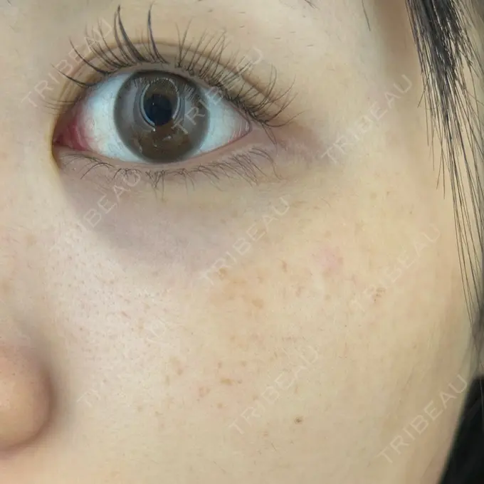 ルメッカ ゆきスキンクリニック 東池袋 DAY 0 メイン用