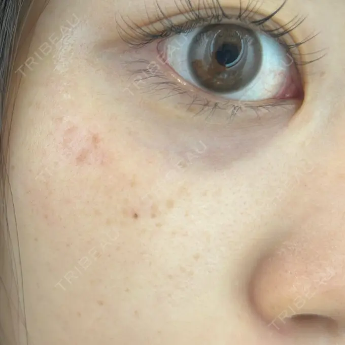 ルメッカ ゆきスキンクリニック 東池袋 DAY 0 メイン用