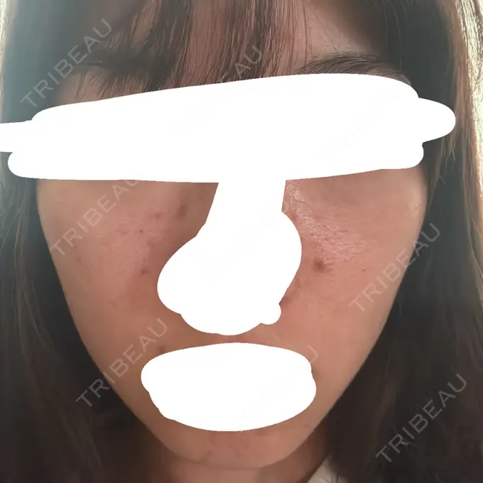 アグネス / ニキビ治療 日本ウェルネス再生クリニック DAY 4 メイン用