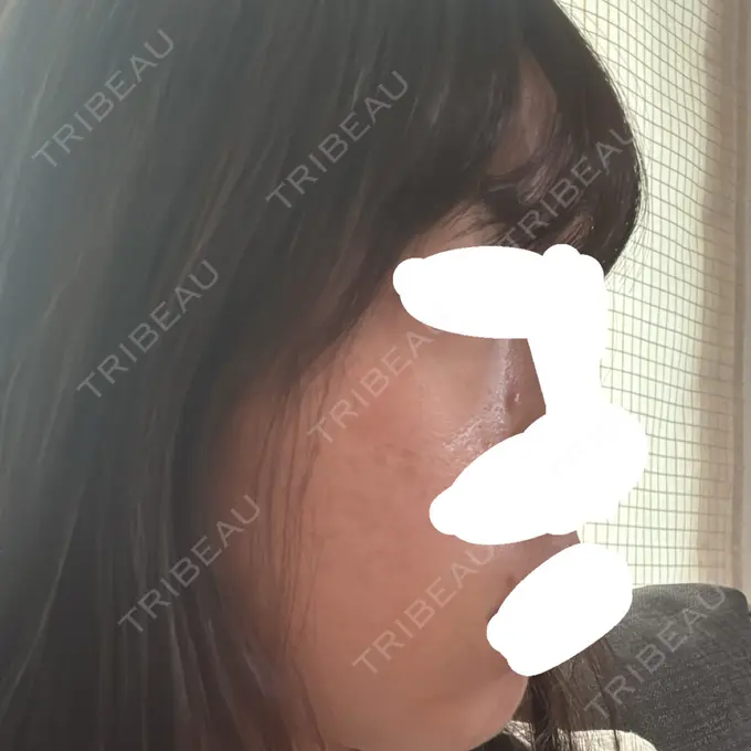 アグネス / ニキビ治療 日本ウェルネス再生クリニック DAY 4 メイン用