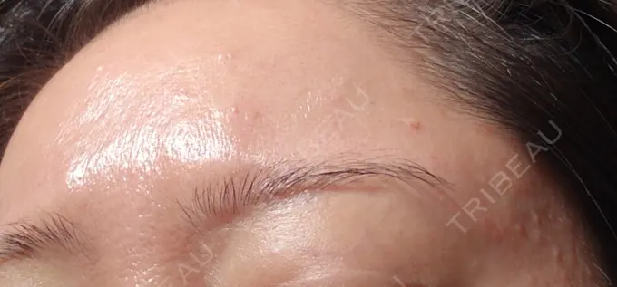 ニードルRF（ポテンツァなど） A CLINIC（エークリニック） 仙台院 AFTER メイン用