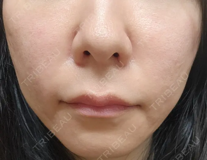 肌ヒアルロン酸注入（たるみ・シワ改善） 湘南美容皮フ科 仙台院 AFTER メイン用