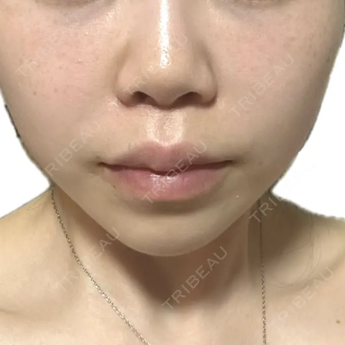 人中短縮 / ヒアルロン酸注入（目の下） / RF（高周波）たるみ治療 BITO BEAUTY CLINIC DAY 9 メイン用