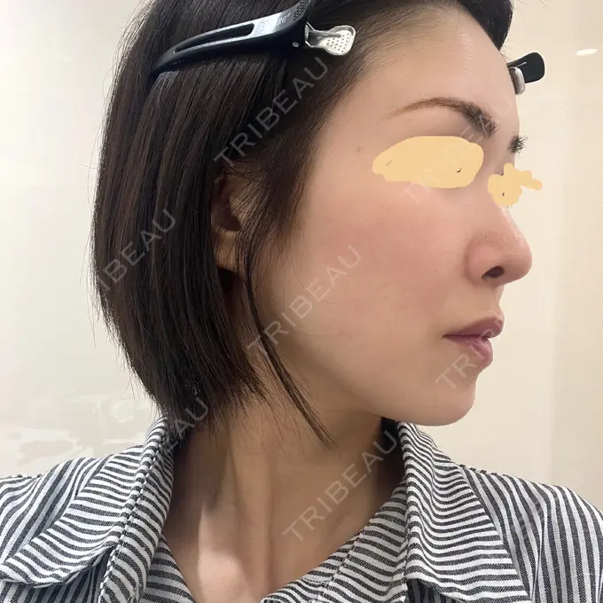 隆鼻術 / 軟骨移植 / 毛穴洗浄（ハイドラフェイシャルなど） / その他（鼻） BIANCA銀座 DAY 175 メイン用