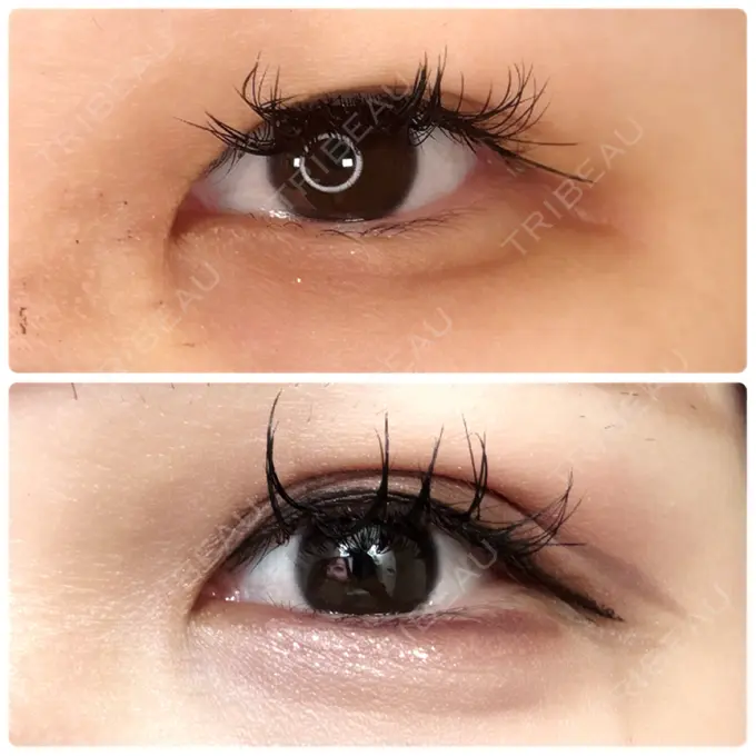 二重埋没 / ヒアルロン酸注入（涙袋） アリエル美容クリニック 横浜院 DAY 4 メイン用