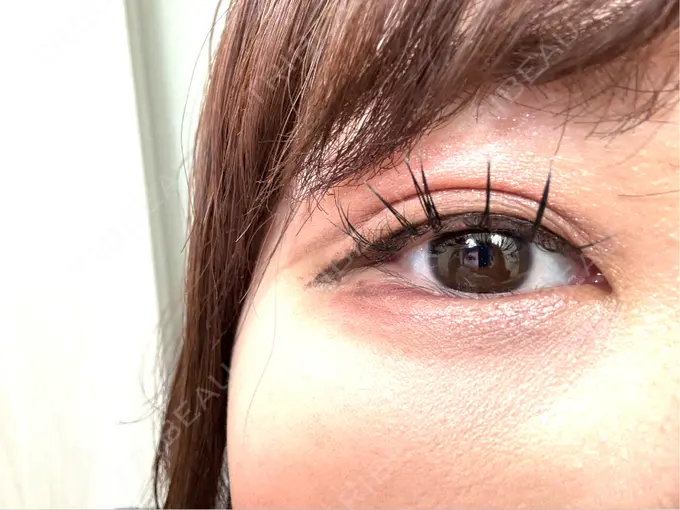 二重埋没 / ヒアルロン酸注入（涙袋） アリエル美容クリニック 横浜院 DAY 5 メイン用