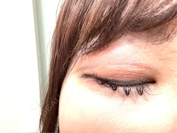 二重埋没 / ヒアルロン酸注入（涙袋） アリエル美容クリニック 横浜院 DAY 5 メイン用