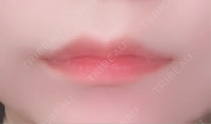 二重埋没 / ヒアルロン酸注入（涙袋） アリエル美容クリニック 横浜院 DAY 5 メイン用