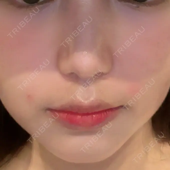 ヒアルロン酸注入（鼻翼基部） 共立美容外科 福岡院 DAY 0 メイン用