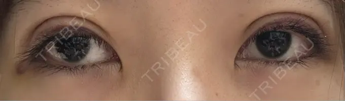 二重埋没 アリエル美容クリニック 水戸院 DAY 7 メイン用