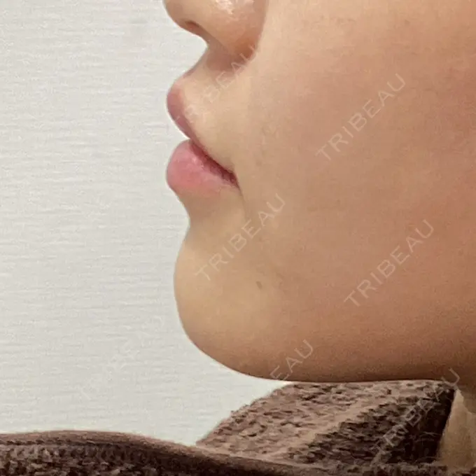 ヒアルロン酸注入（唇） / ボトックス（口角） フィラークリニック 大阪梅田院 DAY 1 メイン用