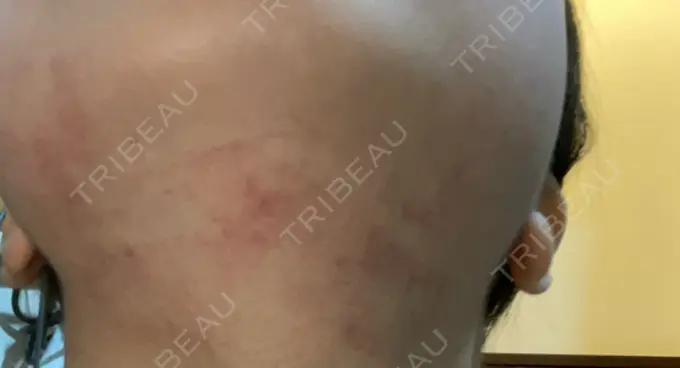 シワ取りボトックス / RF（高周波）たるみ治療 東京シルククリニック 東京神田院 AFTER メイン用