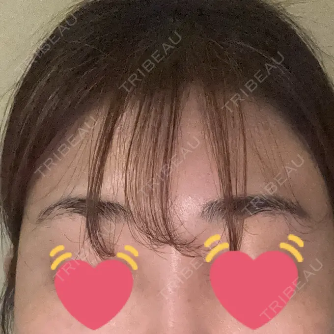 シワ取りボトックス / ボトックス（眉間） 銀座美容外科クリニック 銀座院 DAY 1 メイン用