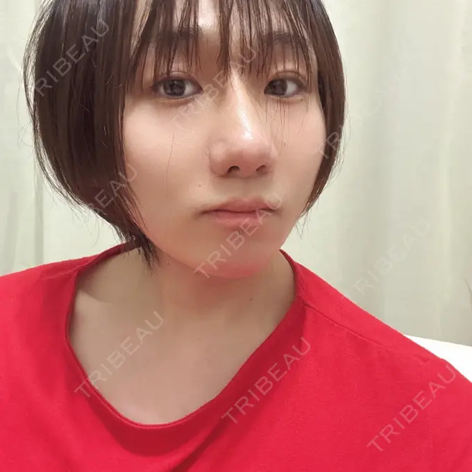 鼻尖形成（切開） / 小鼻縮小（切開） / 軟骨移植 / 骨切幅寄せ / 鼻尖縮小 id（アイディ）美容外科 AFTER メイン用