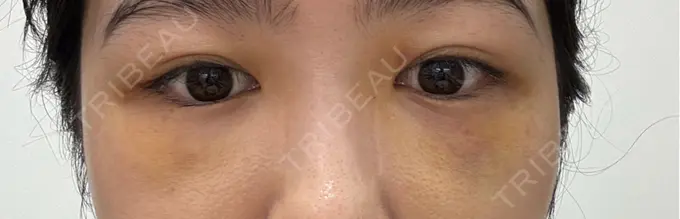 クマ治療 / 下まぶたの脂肪取り RIVER CLINIC（リバークリニック） DAY 4 メイン用