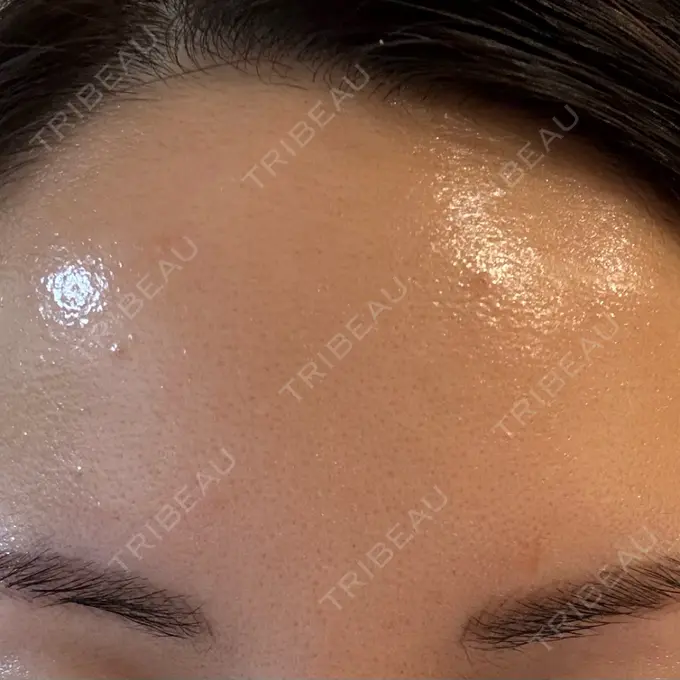 シワ取りボトックス 福岡TAクリニック DAY 16 メイン用