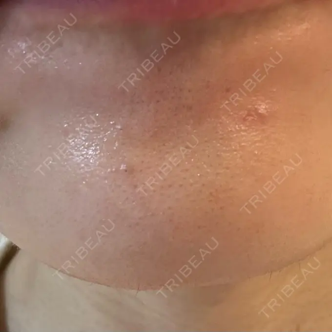 シワ取りボトックス 福岡TAクリニック DAY 16 メイン用