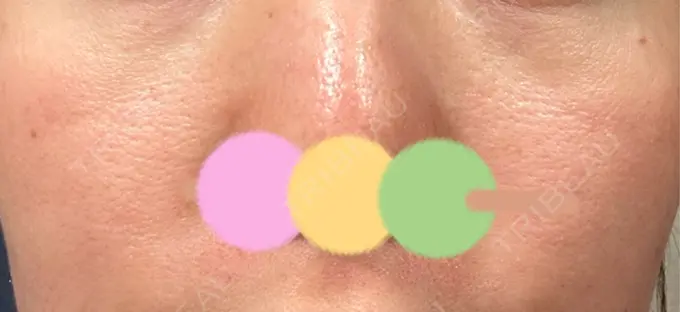 その他（肌） シンデレラ＆ダヴィンチクリニック DAY 0 メイン用