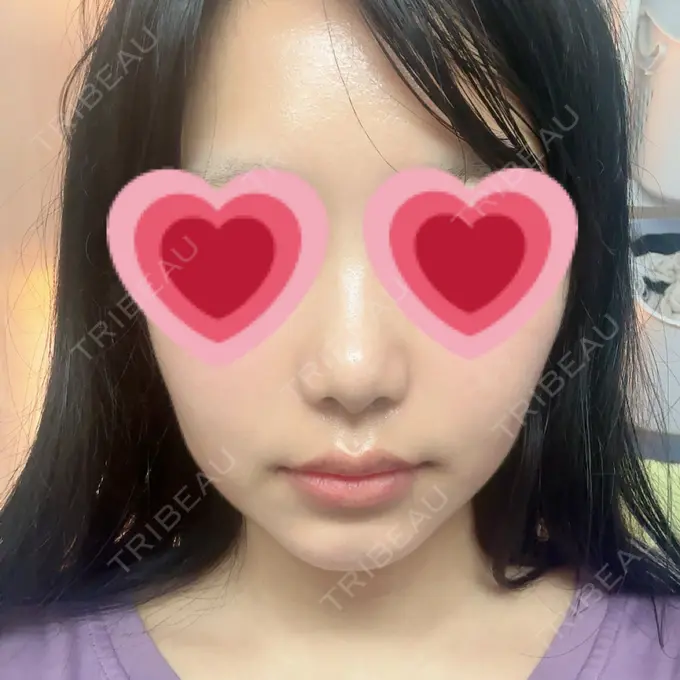 ヒアルロン酸注入（鼻翼基部） 共立美容外科 福岡院 DAY 1 メイン用