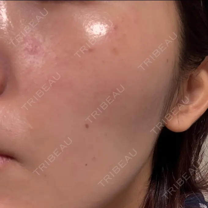 ルメッカ plume clinic DAY 0 メイン用