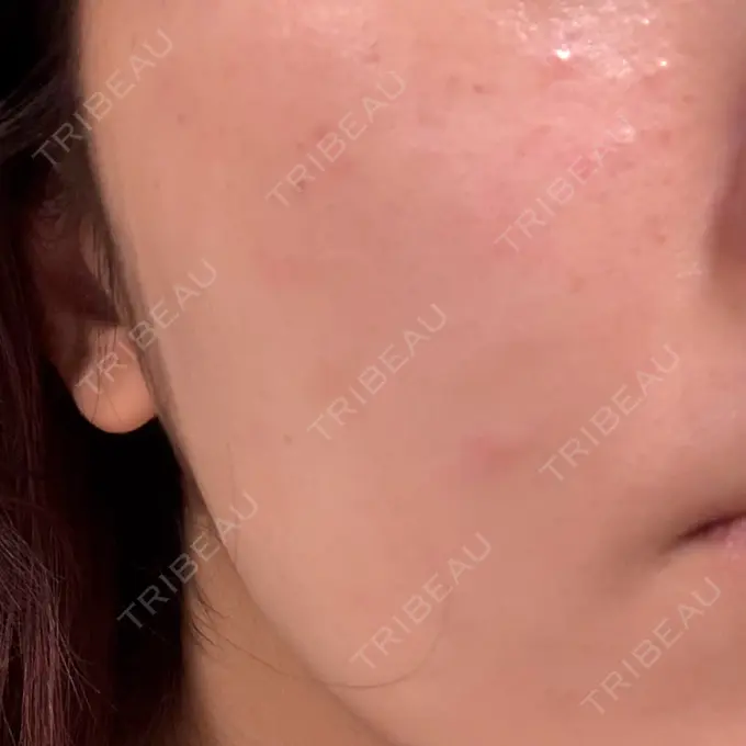 ルメッカ plume clinic DAY 0 メイン用