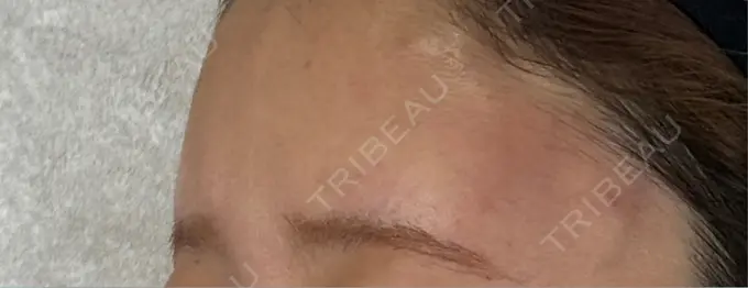 ヒアルロン酸注入（額） / ボトックス（額） アリエル美容クリニック 横浜院 DAY 0 メイン用