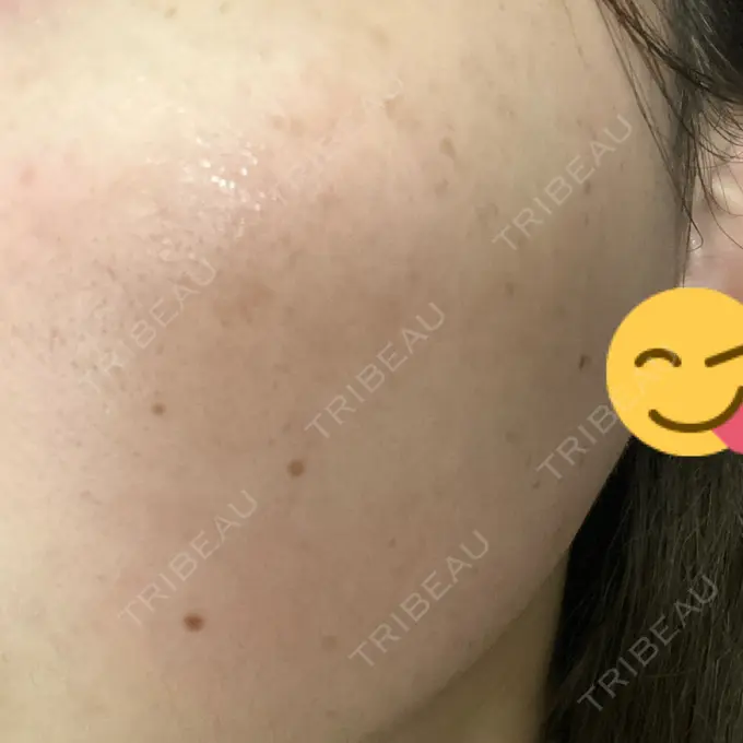 ボトックス（エラ・小顔） 共立美容外科 名古屋院 DAY 7 メイン用