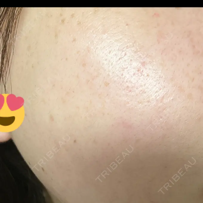 ボトックス（エラ・小顔） 共立美容外科 名古屋院 AFTER メイン用