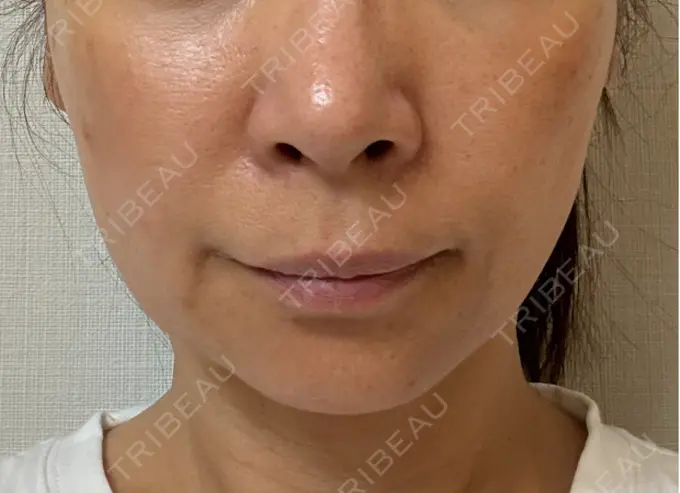 RF（高周波）たるみ治療 ゆきスキンクリニック 東池袋 DAY 3 メイン用