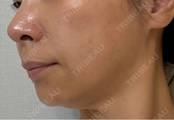 RF（高周波）たるみ治療 ゆきスキンクリニック 東池袋 DAY 3 メイン用