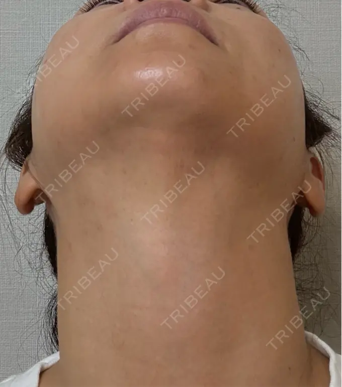 RF（高周波）たるみ治療 ゆきスキンクリニック 東池袋 DAY 3 メイン用