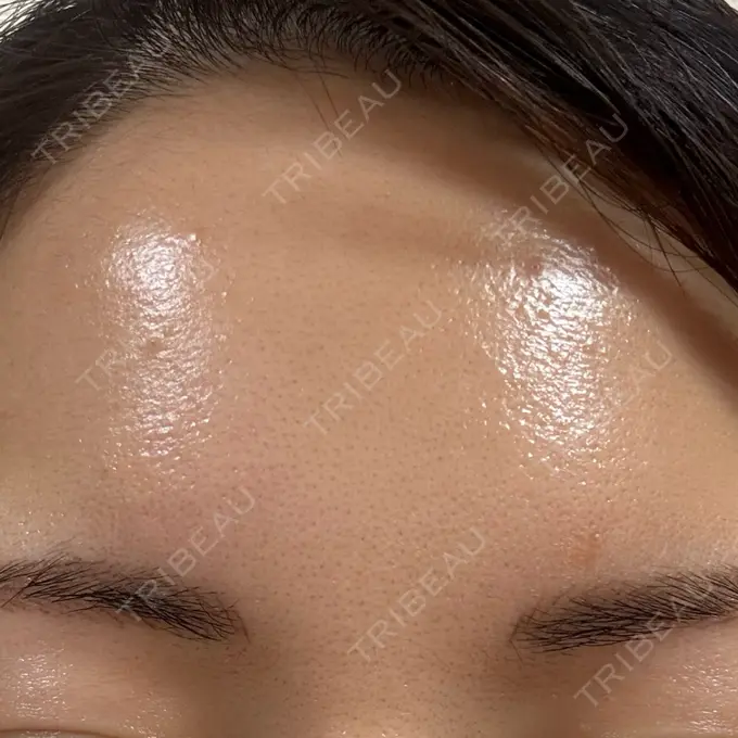 シワ取りボトックス 福岡TAクリニック DAY 17 メイン用