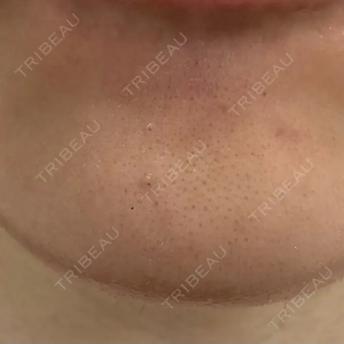 シワ取りボトックス 福岡TAクリニック DAY 17 メイン用