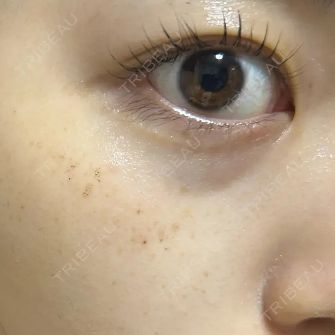 ルメッカ ゆきスキンクリニック 東池袋 DAY 3 メイン用