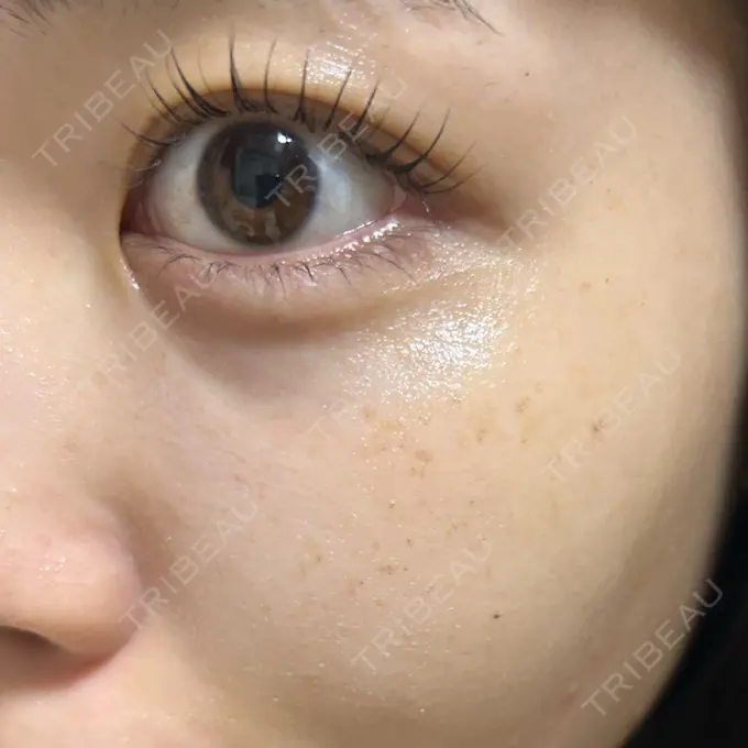 ルメッカ ゆきスキンクリニック 東池袋 DAY 3 メイン用