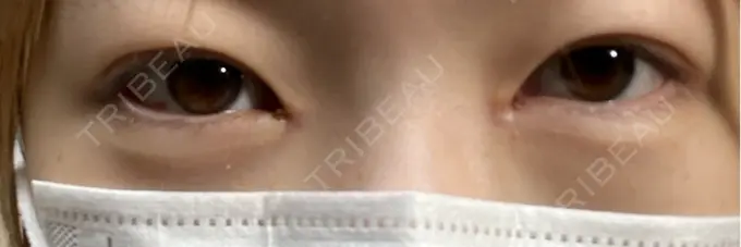 クマ治療 / ヒアルロン酸注入（目の下） BITO BEAUTY CLINIC DAY 9 メイン用