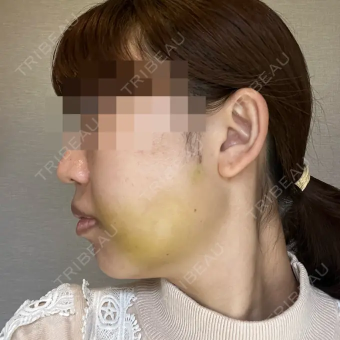 糸リフト / 脂肪吸引（顔） / 脂肪吸引注射（顔） ziz CLINIC DAY 4 メイン用