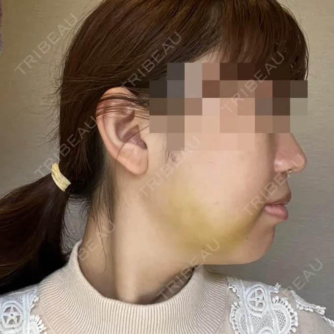 糸リフト / 脂肪吸引（顔） / 脂肪吸引注射（顔） ziz CLINIC DAY 4 メイン用