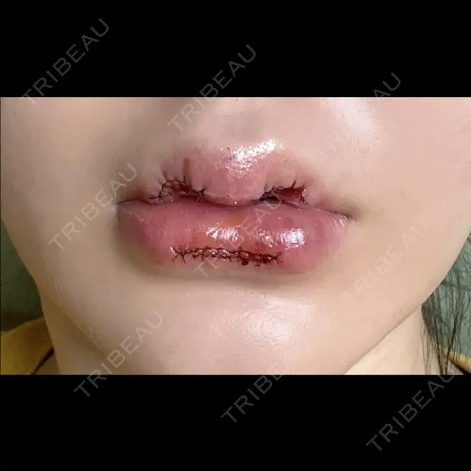 その他（口元） R Beauty CLINIC 銀座院 AFTER メイン用