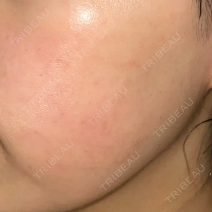 ピコレーザートーニング（美白・肝斑） おおかみ美容のクリニック 横浜院 AFTER メイン用