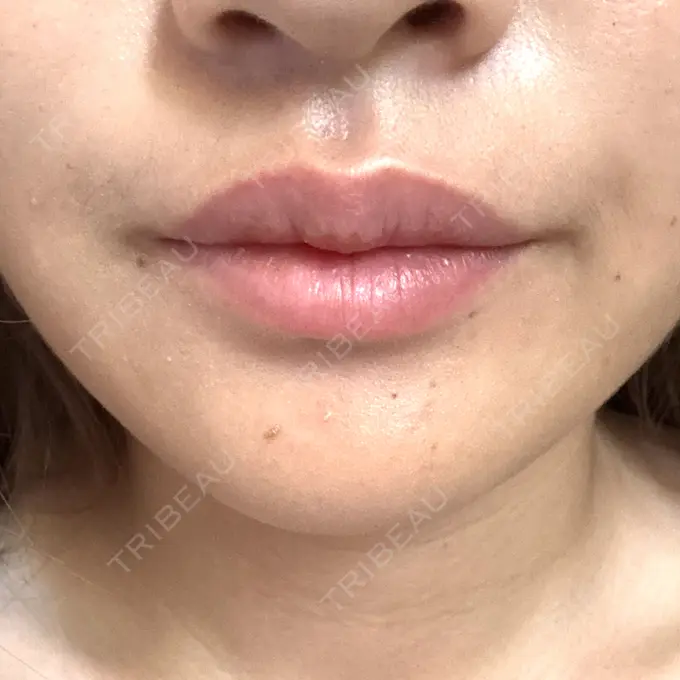 ボトックス（口角） / ボトックス（額） 大美会クリニック 神戸院 DAY 1 メイン用