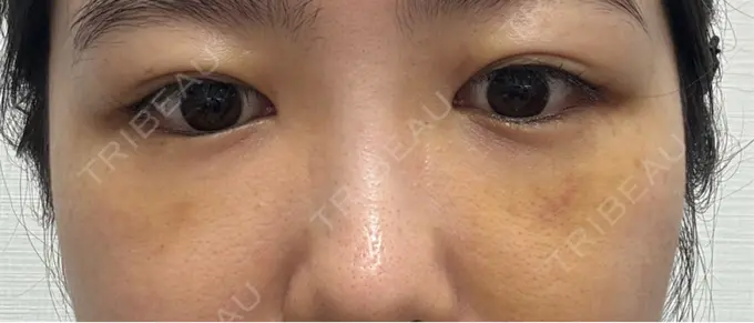 クマ治療 / 下まぶたの脂肪取り RIVER CLINIC（リバークリニック） DAY 5 メイン用