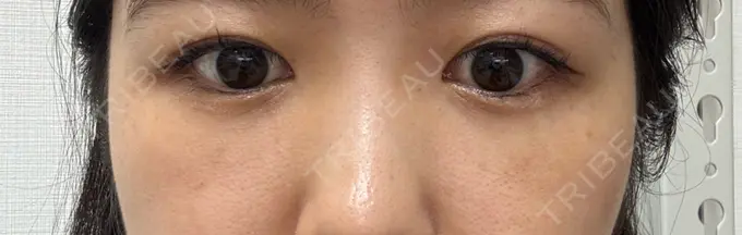 クマ治療 / 下まぶたの脂肪取り RIVER CLINIC（リバークリニック） DAY 7 メイン用