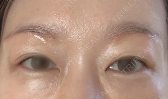 眉下切開 もとび美容外科クリニック 新宿院 DAY 9 メイン用