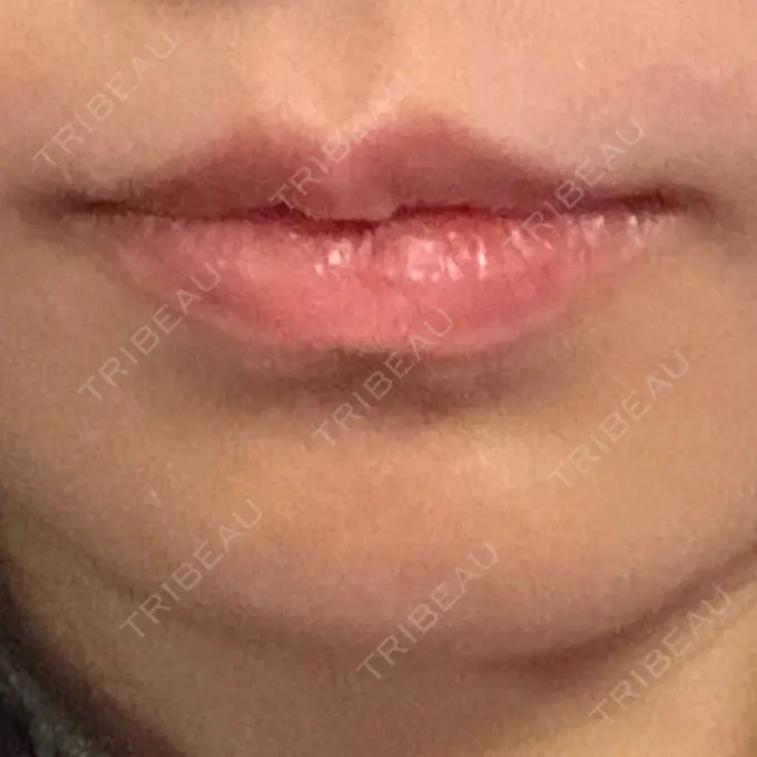 ボトックス（口角） TCB東京中央美容外科 広島院 DAY 15 メイン用